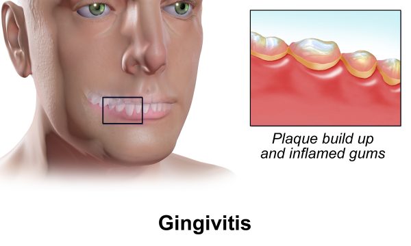 Gingivitis