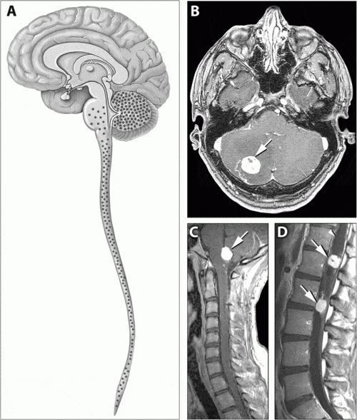 Von Hippel-Lindau Disease