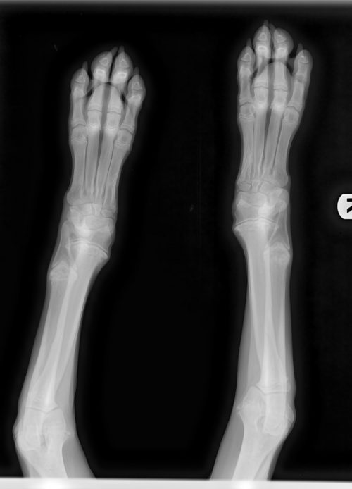 Osteodystrophy