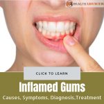 Inflamed Gums