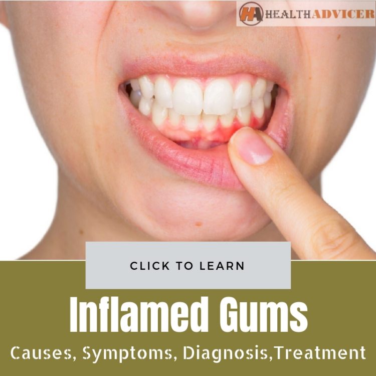 Inflamed Gums