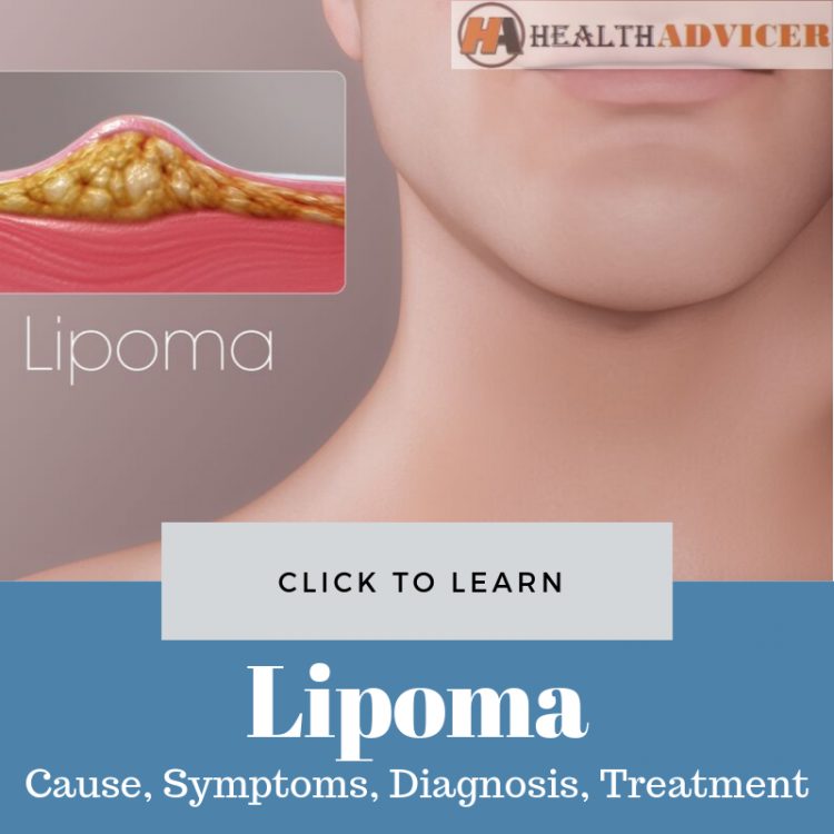 Lipoma Picture