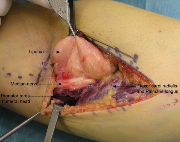 Surgical Removal