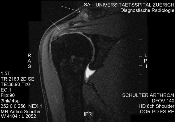 Rotator Cuff Tendinitis Or Shoulder Impingement