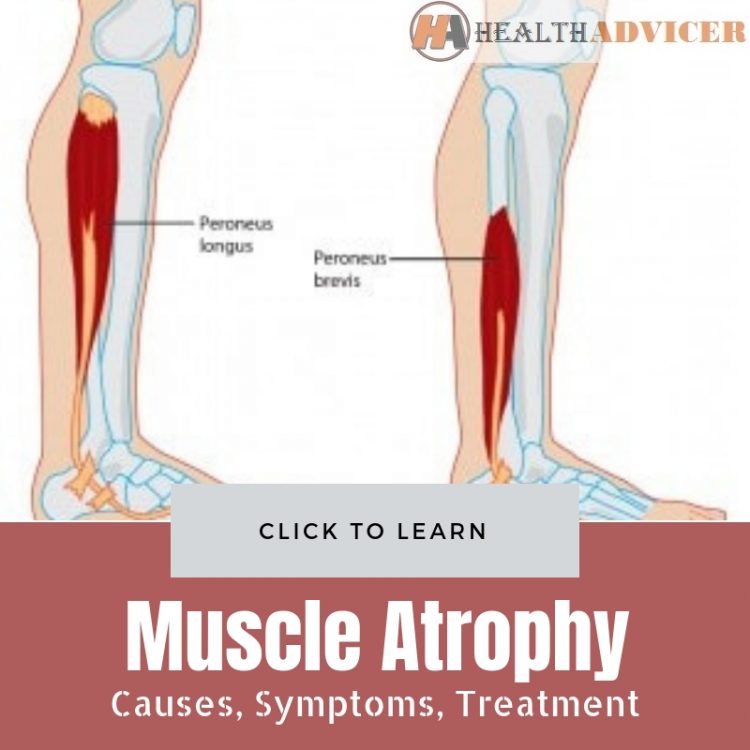 Muscle Atrophy Causes Treatment