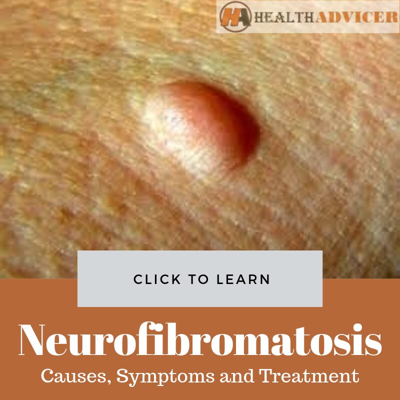 Neurofibromatosis Picture