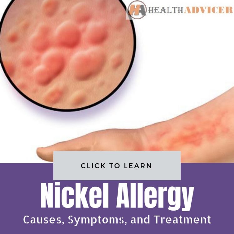 Nickel Allergy Pictures