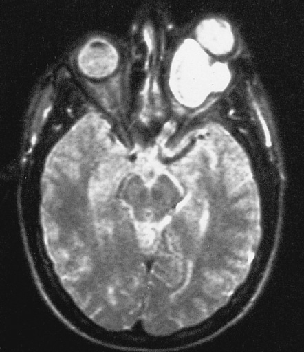 Optic Glioma