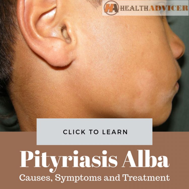 Pityriasis Alba