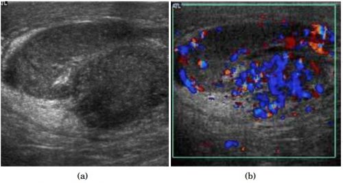 Epididymo-Orchitis