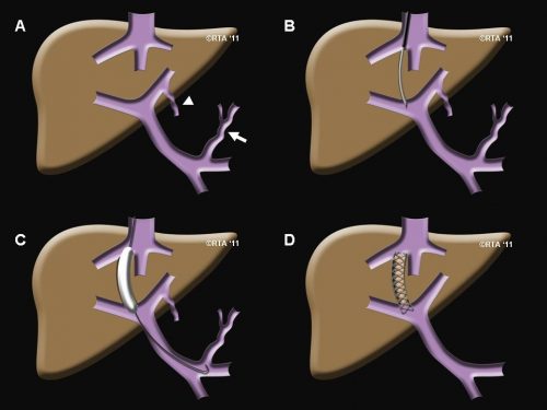 Divert Blood Flow