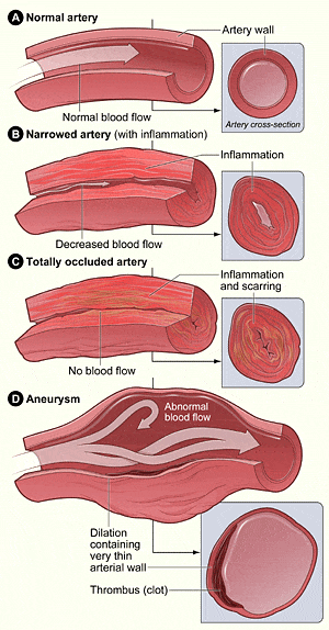 Vasculitis