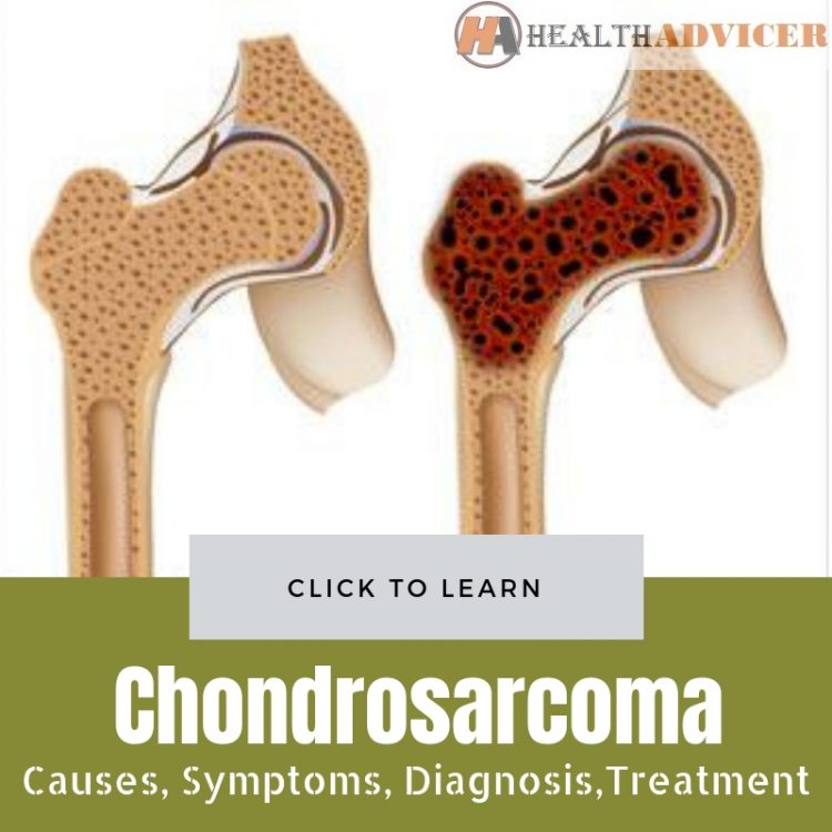 chondrosarcoma bone cancer
