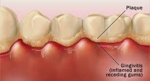 Dental Plaque