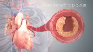 Microvascular Disease