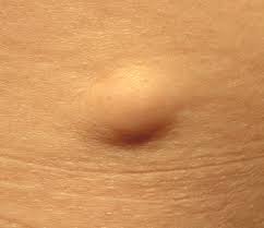 Lipoma