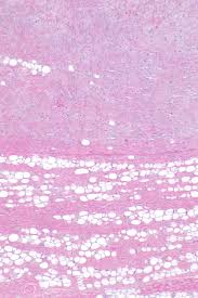 Spindle Cell Lipoma