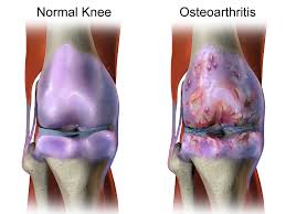 Weakening Of Bones