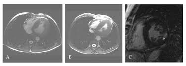 MRI (Magnetic Resonance Imaging)