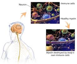 Multiple Sclerosis