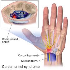 Carpal Tunnel Syndrome