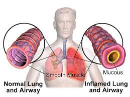 bronchospasm