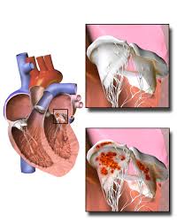 Endocarditis