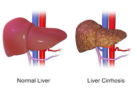 Cirrhosis