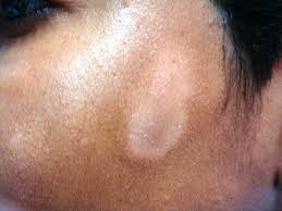 Appearance Of Pityriasis Alba