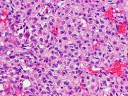Chondrosarcoma