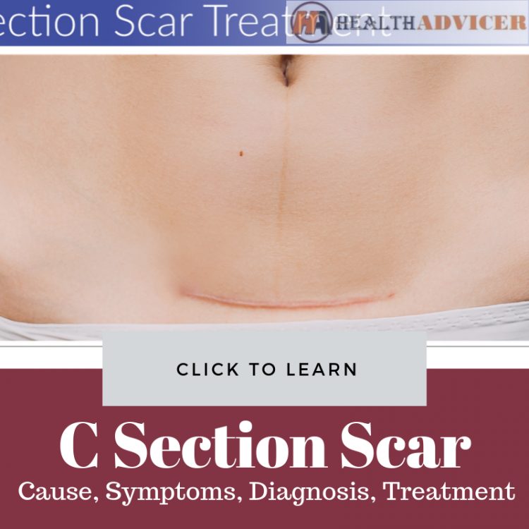 C Section Scar