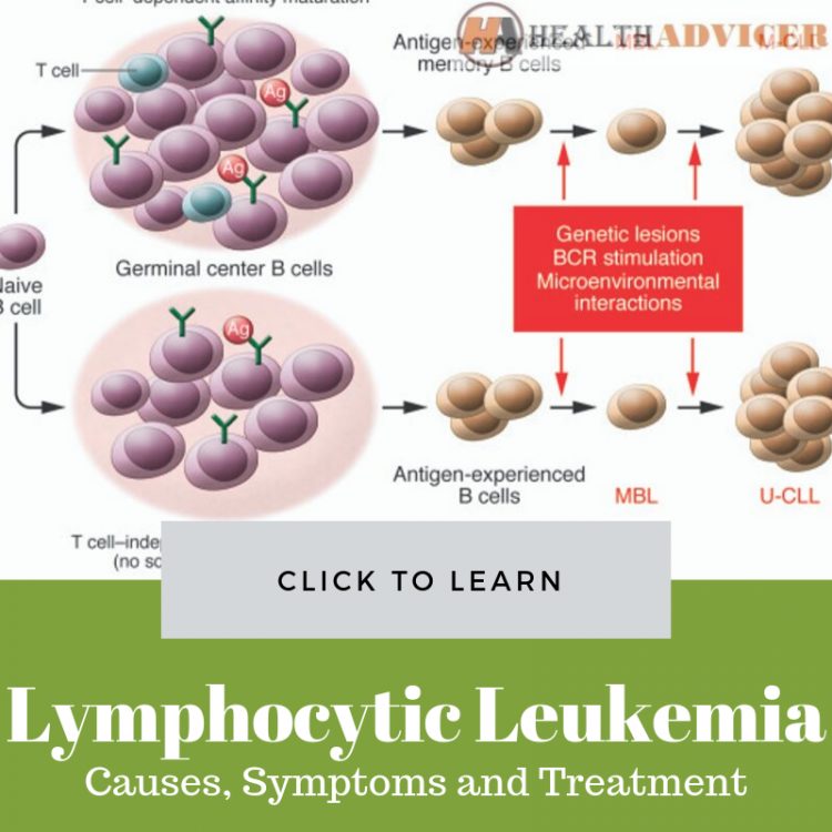 Chronic Lymphocytic Leukemia