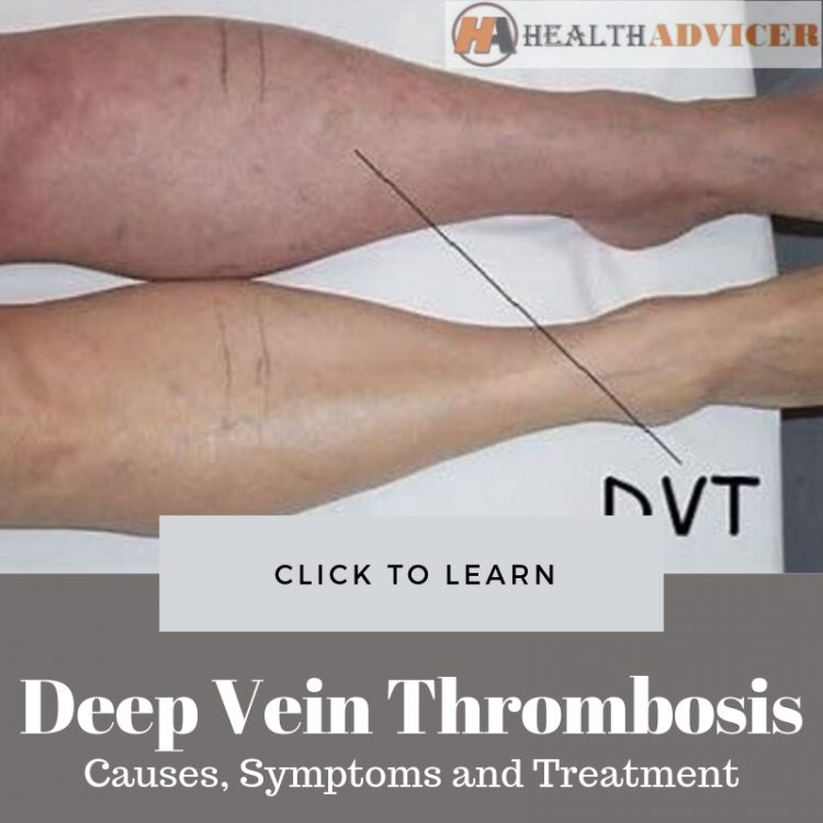 Deep Vein Thrombosis