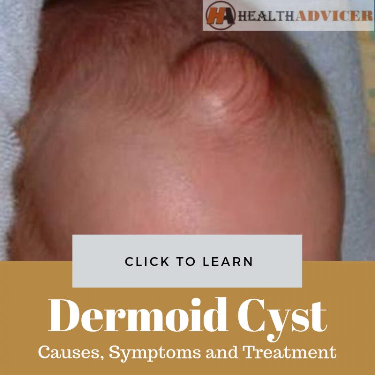 Dermoid Cyst