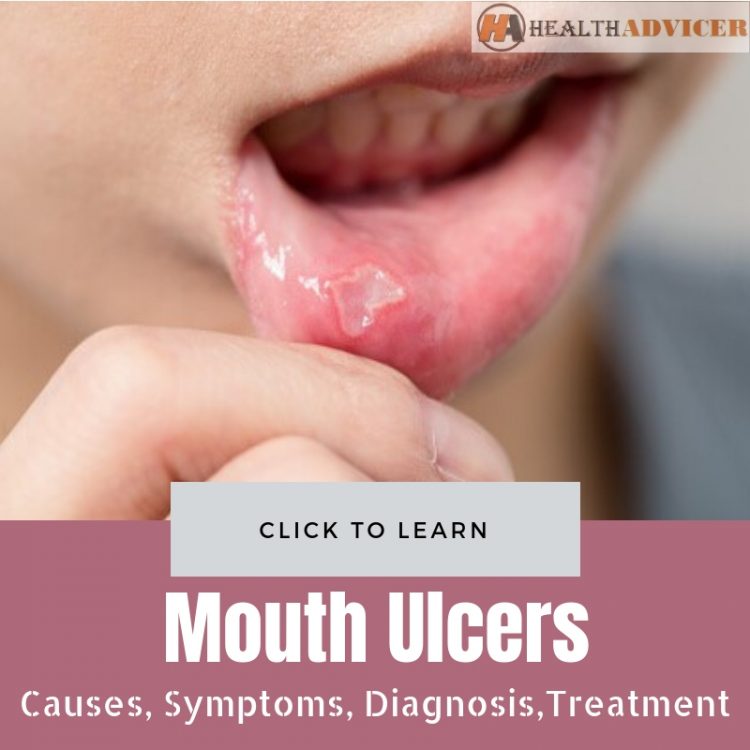 Mouth Ulcers Picture