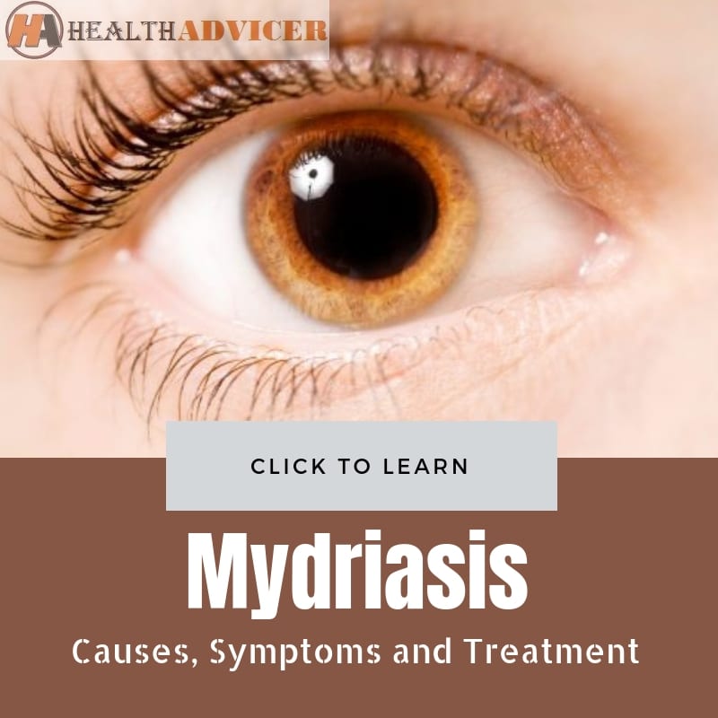 Mydriasis Causes treatment