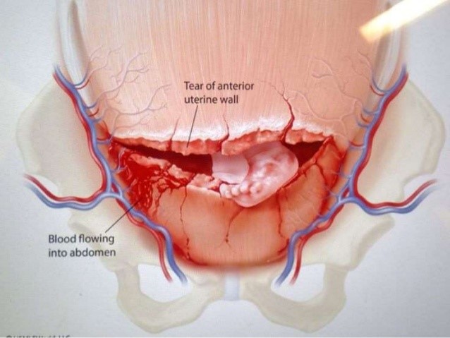 Uterine Rupture