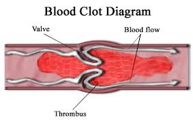 Inheriting Blood Clots Disorder