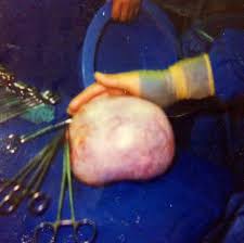 Ovarian Dermoid Cyst