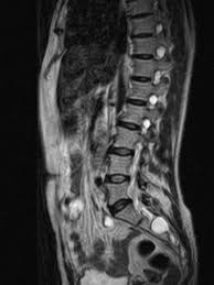 Spinal Dermoid Cyst