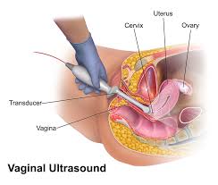 Transvaginal Ultrasound