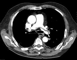 Pulmonary Embolism