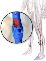 deep vein thrombosis