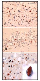 Symptoms of Pick's Disease