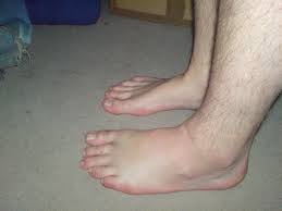Swelling In Legs And Ankles