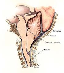 Type 2 Arnold-Chiari Malformation