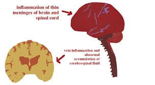 Meningitis