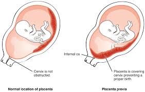 Placenta Praevia