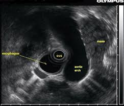 Endoscopic Ultrasound