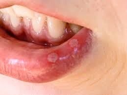 Mouth Ulcers